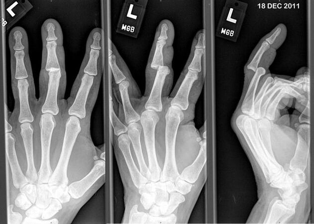 X-ray of the displaced fingers