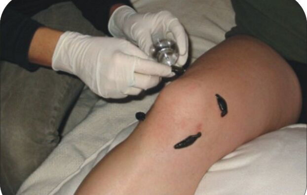 Placement of leeches on a sore knee joint