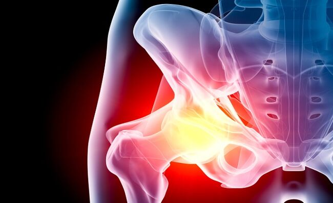 arthropathy of the hip joint
