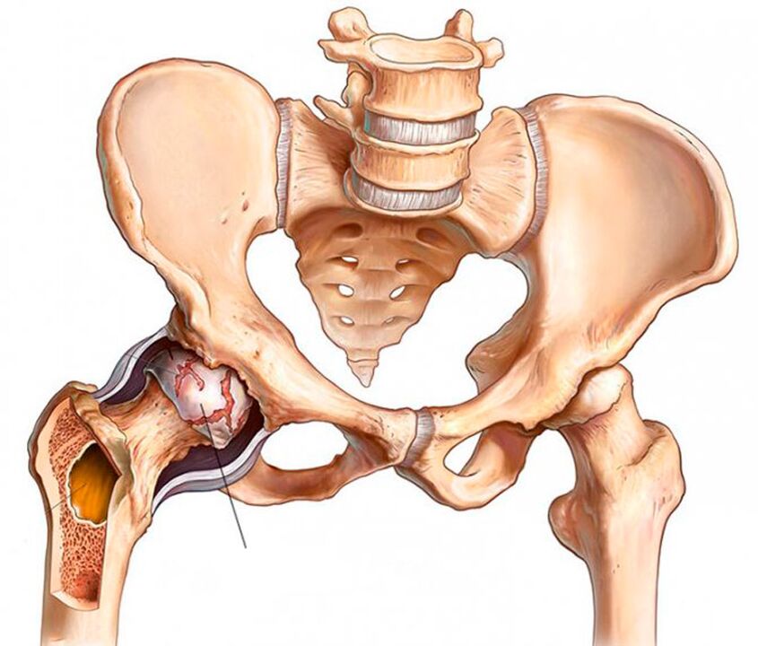 Arthropathy of the hip joint