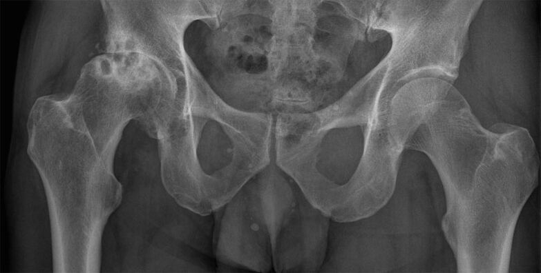 Deformative arthropathy of the hip joint on radiography