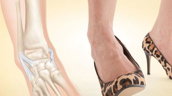 wearing high-heeled shoes as a cause of ankle sprains