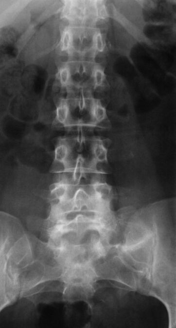For the diagnosis of lumbar osteochondrosis, an X-ray is performed