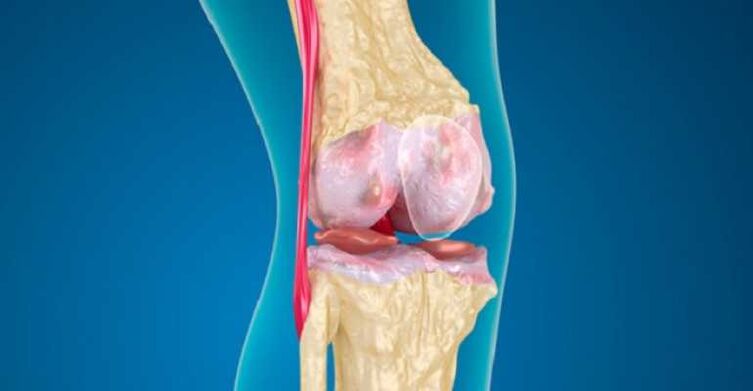 Arthritis of knee joints, which causes cartilage to be destroyed in joints