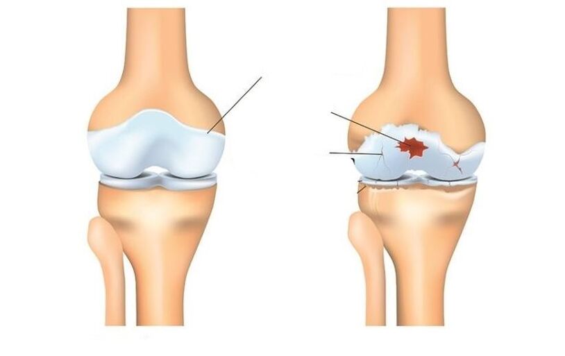 Healthy and patients with joints