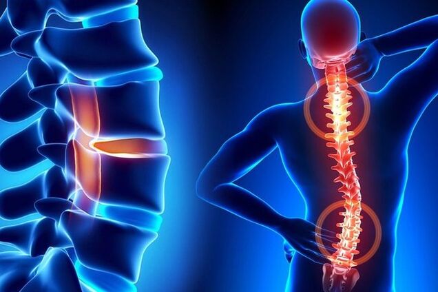 Osteochondrosis of the spine
