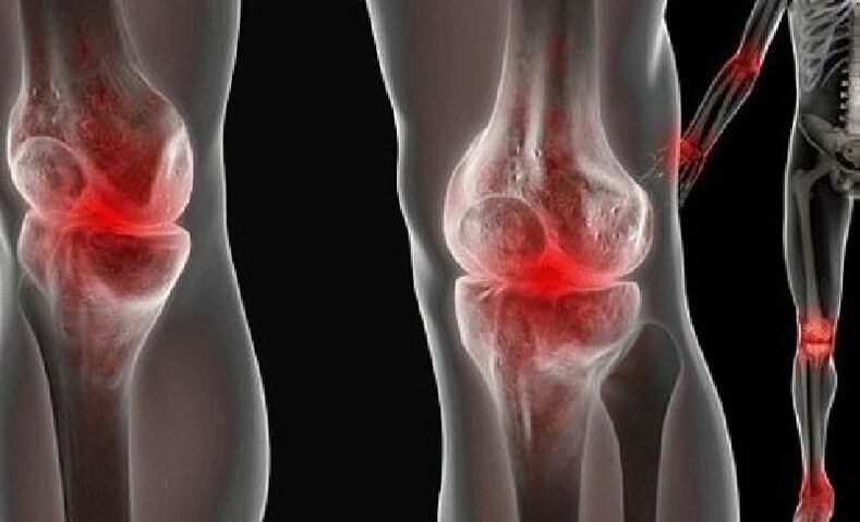 symptoms of gonoarthrosis of joints