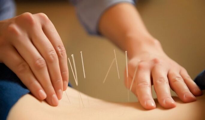 acupuncture for the treatment of lower back pain