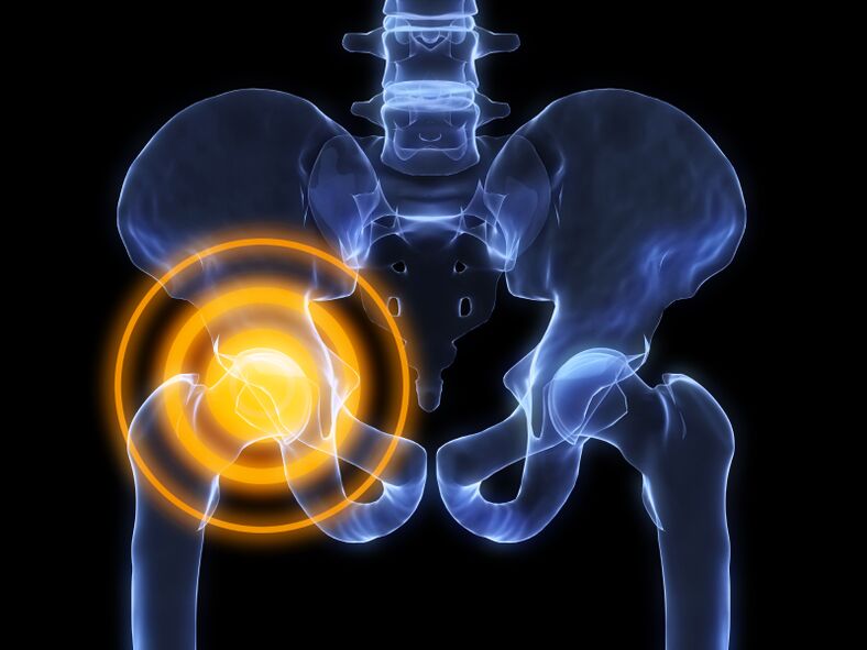 arthropathy of the hip joint
