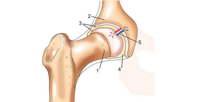 hip joint and arthropathy